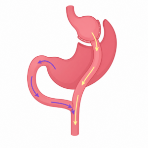 Bariatric Surgery Instruments